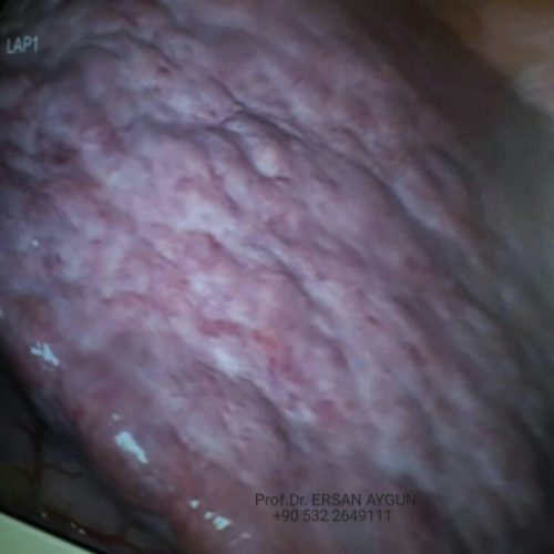 KARACİĞER  KANSERLERİ  NELERDİR,NASIL TEDAVİ  EDİLİRLER?