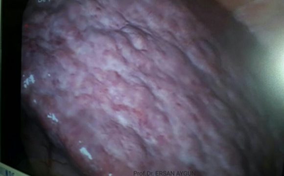 KARACİĞER  KANSERLERİ  NELERDİR,NASIL TEDAVİ  EDİLİRLER?