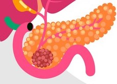 PANKREAS KANSERİ NEDİR, NASIL TEDAVİ EDİLİR?