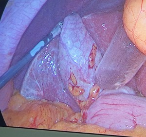  SAFRA KESESİ TAŞLARI NASIL TEDAVİ EDİLİR?