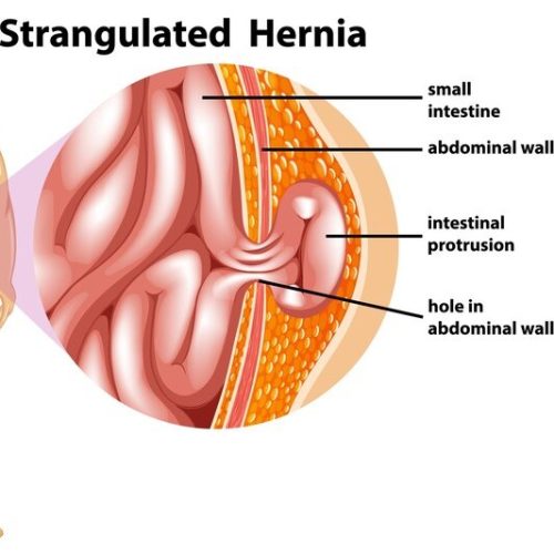 GÖBEK (UMBLİKAL) FITIKLARI   NEDİR?  Niçin Oluşurlar ve Nasıl Tedavi Edilmelidirler?